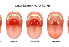 Photo of Популярные методы борьбы с ангиной