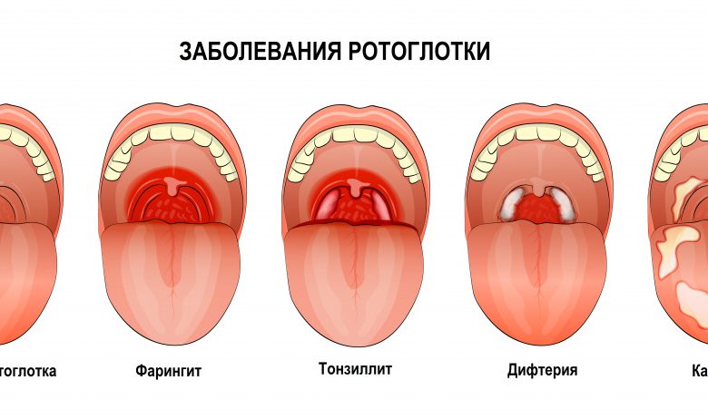Photo of Популярные методы борьбы с ангиной