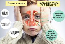 Photo of Как справиться с сильным насморком