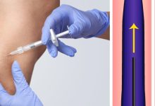 Photo of Современные подходы к лечению варикоза