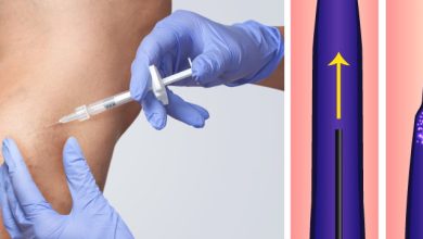 Photo of Современные подходы к лечению варикоза