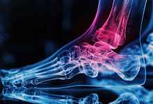 Photo of Методы лечения остеоартрита стоп